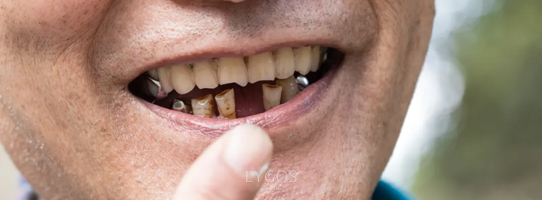 What Causes Teeth Stains?