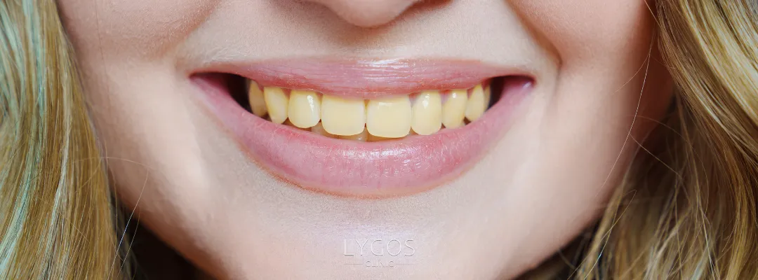 Why Do Teeth Turn Yellow?