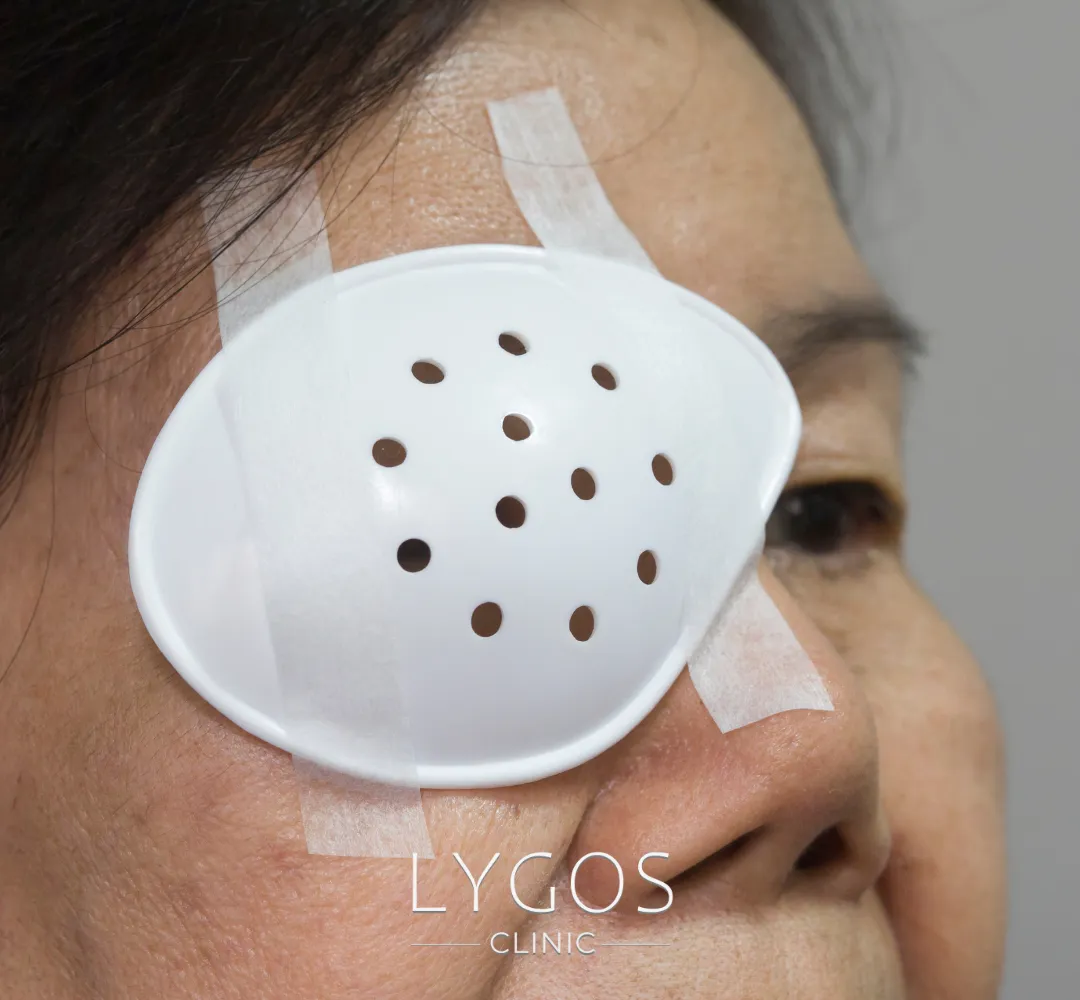 Smart Lens (Intraocular Lens) 22 Akıllı Lens Ameliyatı Sonrası