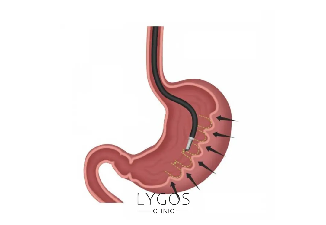Gastric Reduction Surgery 18 Ameliyatsız Mide Küçültme
