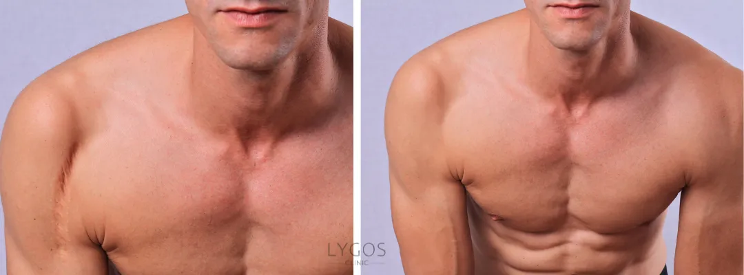 Before and After Razor Scar Laser Treatment