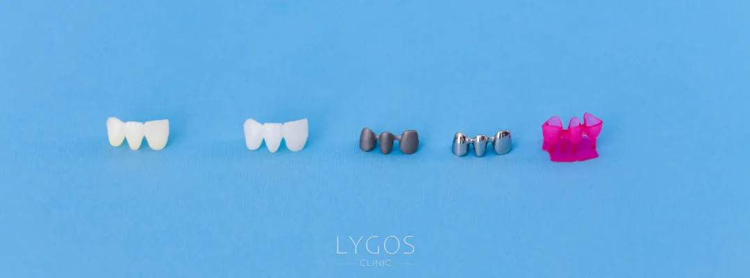 What are the types of dental crowns?