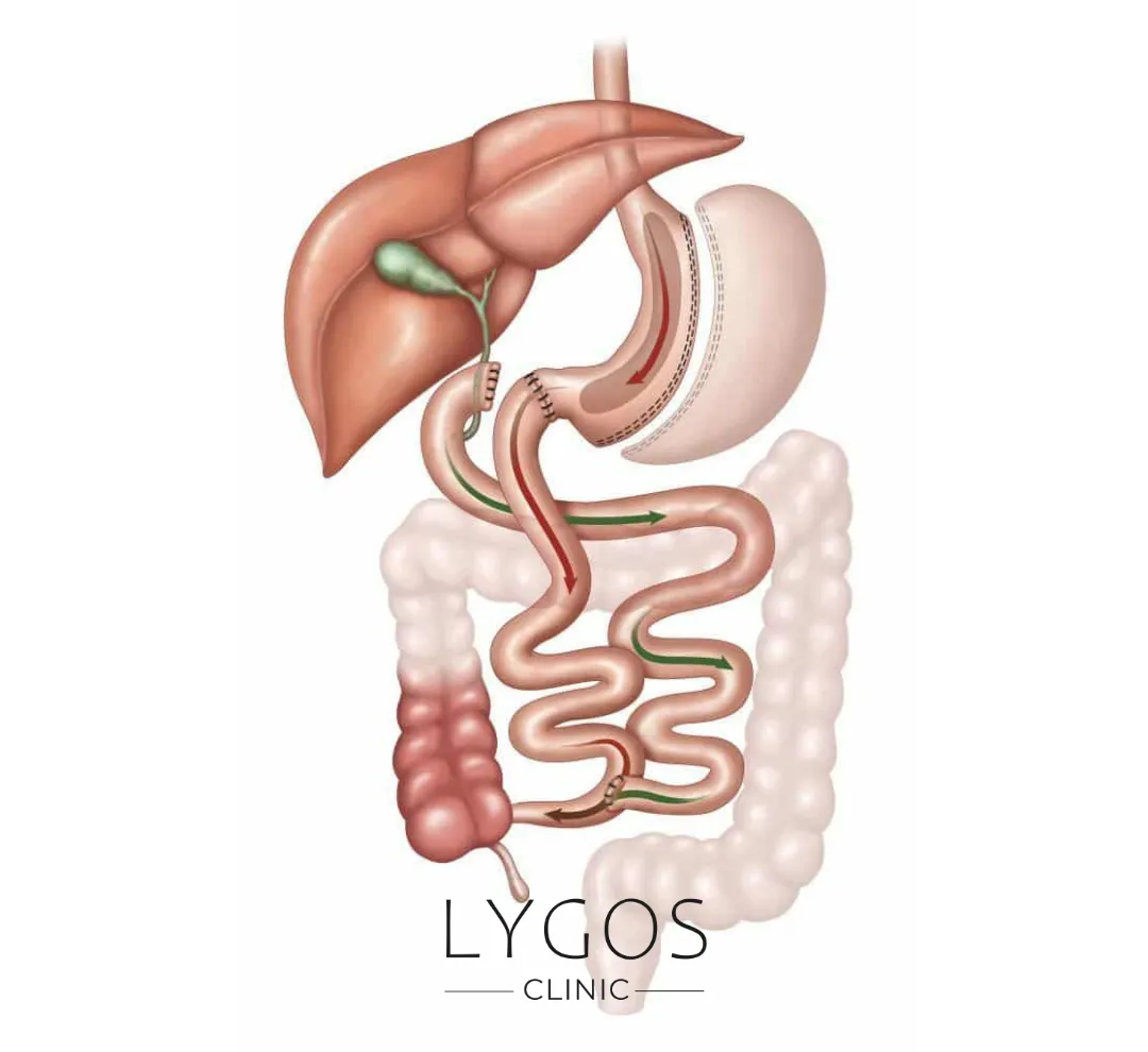 Duodenal Switch Surgery 11 Duodenal Switch Ameliyatı Nasıl Yapılır