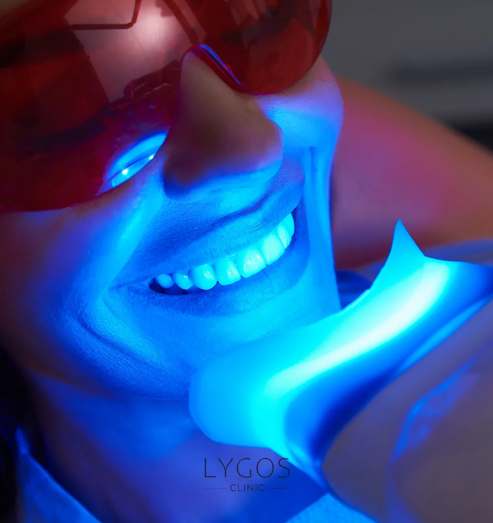 Teeth Whitening 25 Lazerle Diş Beyazlatma