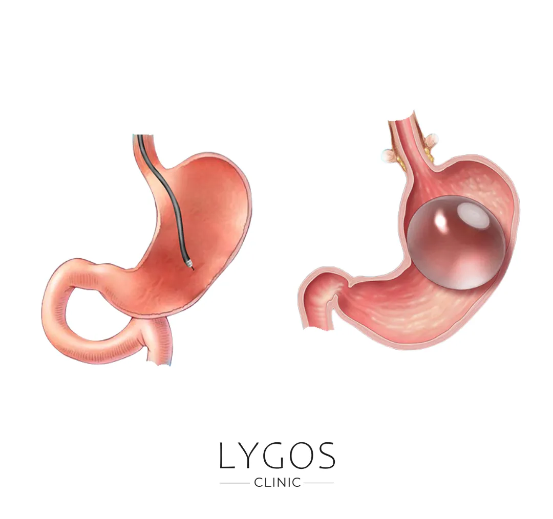 Gastric Botox 13 Mide Botoksu ve Mide Balonu Arasındaki Fark Nedir?