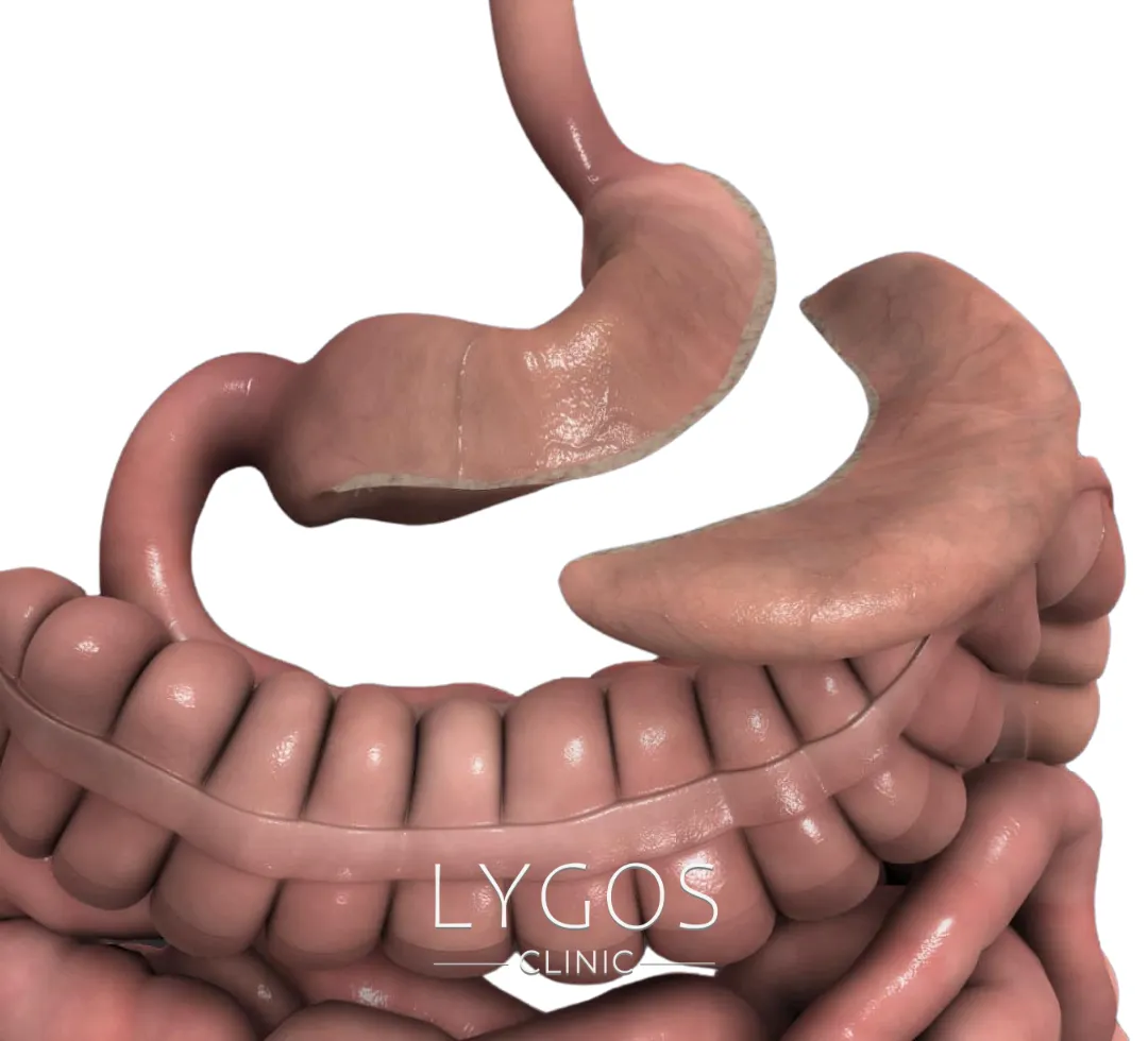 Gastric Reduction Surgery 10 Mide Küçültme Ameliyatı Nedir