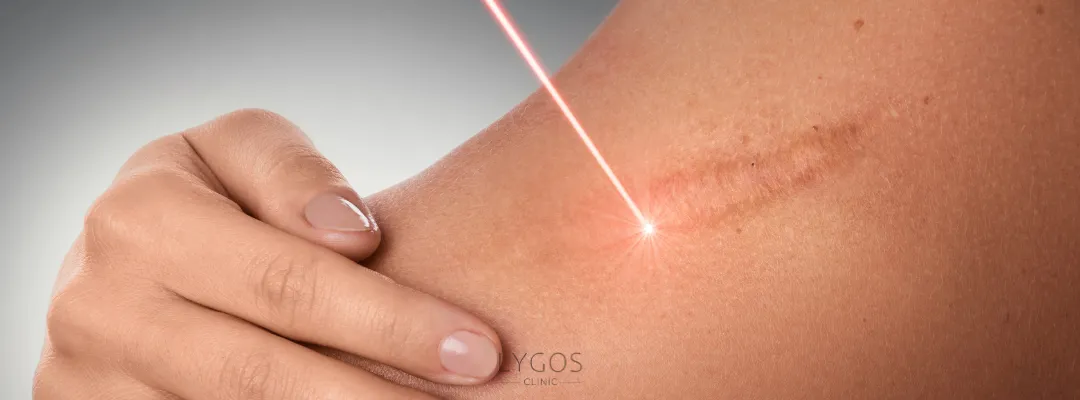 Razor Scar Laser Treatment