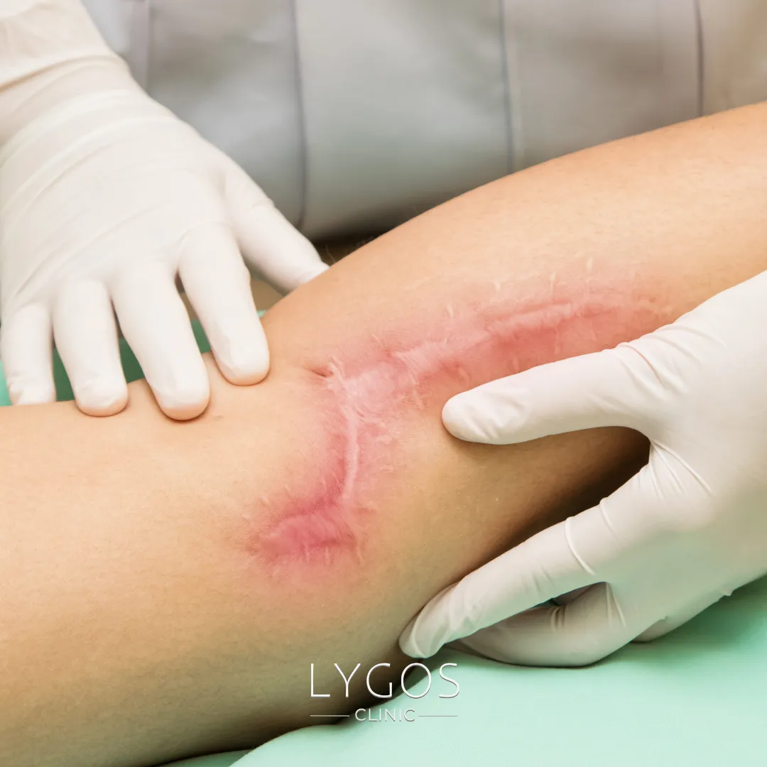 Razor Scars Treatment | How to Treat Razor Scars 1 Razor Scars