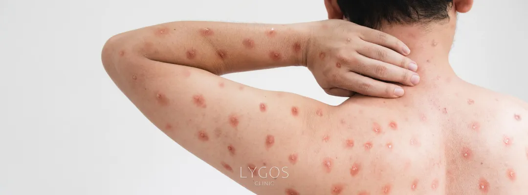 What are the Symptoms of Monkeypox Virus?