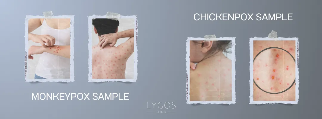 What is the Difference Between Monkeypox and Chickenpox?