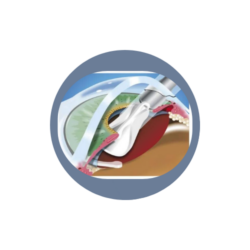 Smart Lens (Intraocular Lens) 16 Akilli Lensin Yerlestirilmesi 1 1