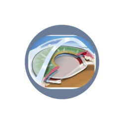 Smart Lens (Intraocular Lens) 17 Yara Kapatma 1