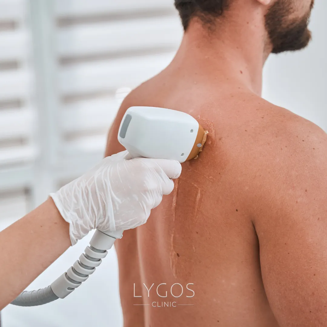 Laser Hair Removal Burn | Treatment Methods | LYGOS 2025 1 Causes of Laser Hair Removal Burns