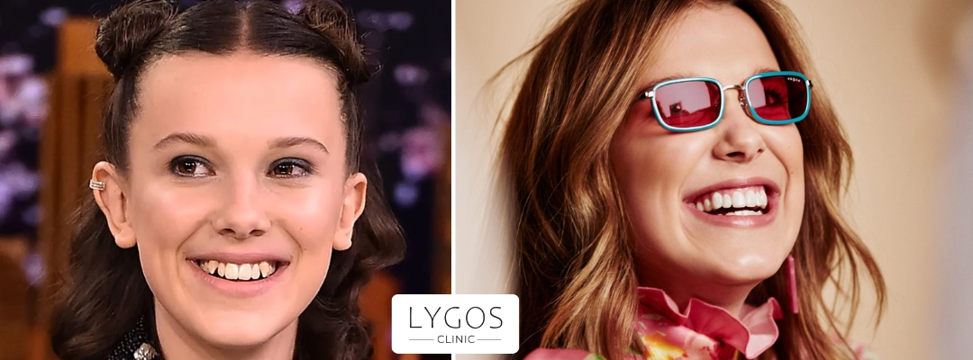 Millie Bobby Brown'ın Dişlerinin Öncesi ve Sonrası