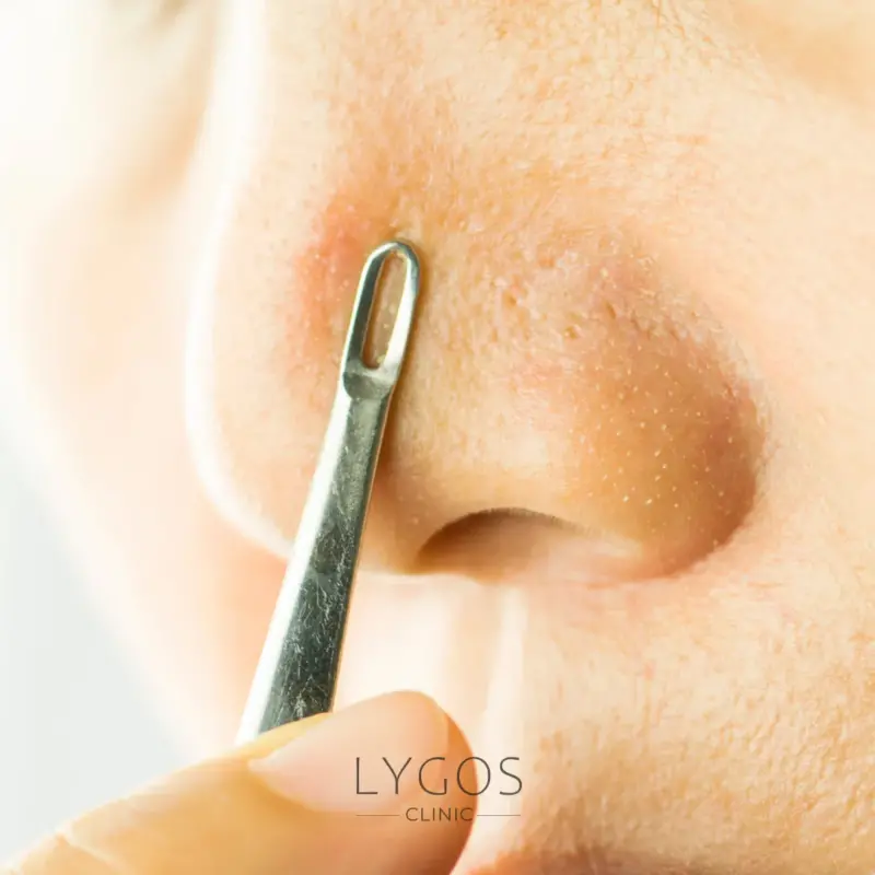 What are Whiteheads?