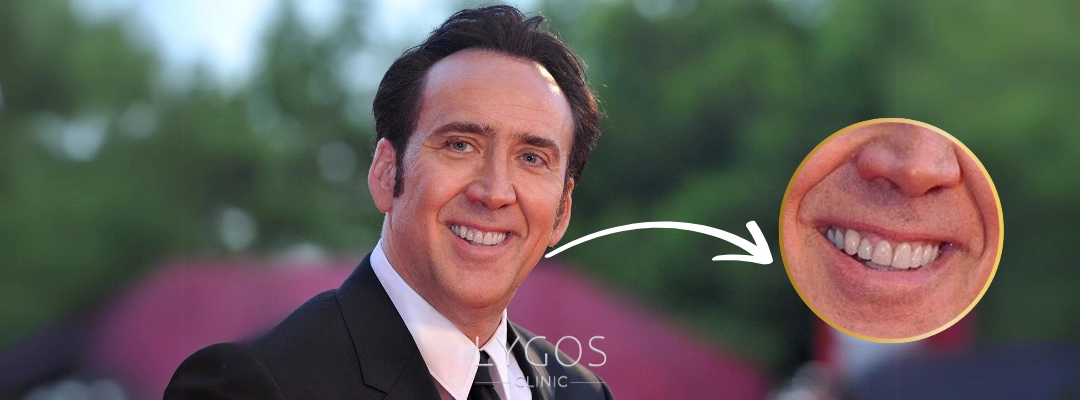 Nicolas Cage Teeth Transformation