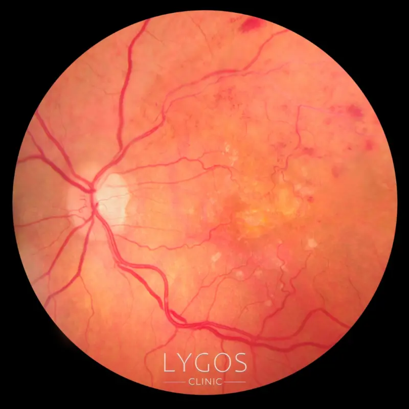 Retinopati Tedavisi