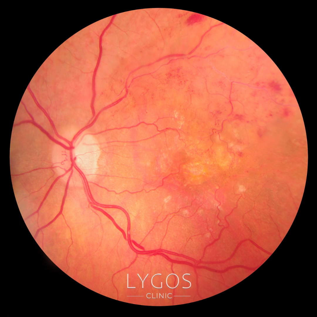 Retinopati Nedir? | Diyabetik Retinopati | LYGOS 2025 1 Retinopati Tedavisi