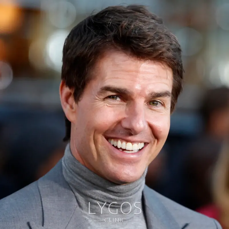 Tom Cruise Teeth Veneer