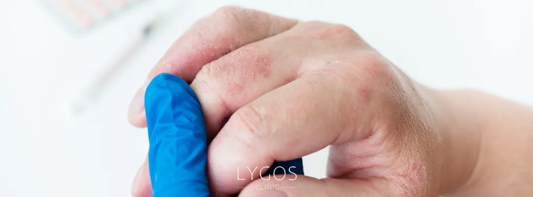 Eczema Atopic Dermatitis Causes