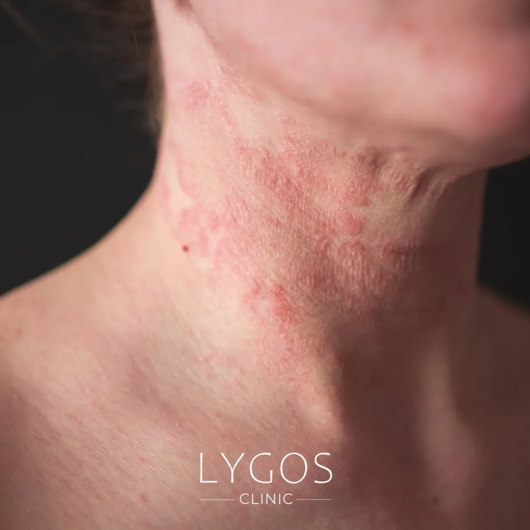 Eczema Atopic Dermatitis | Symptoms and Causes | LYGOS 2025 1 Eczema Atopic Dermatitis