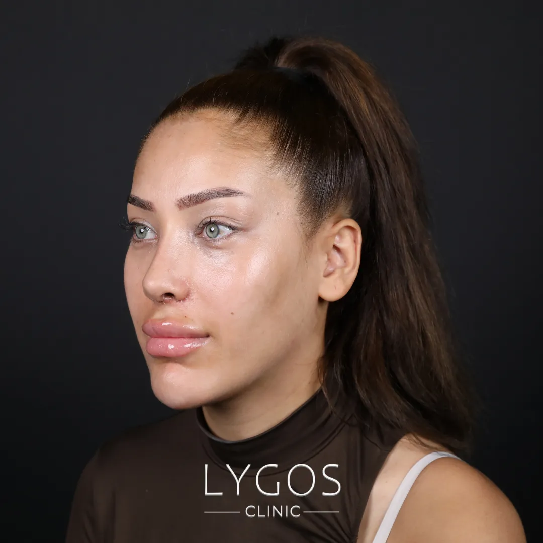 Septorhinoplasty (Nose Curvature Surgery) | LYGOS 2025 1 Septorhinoplasty