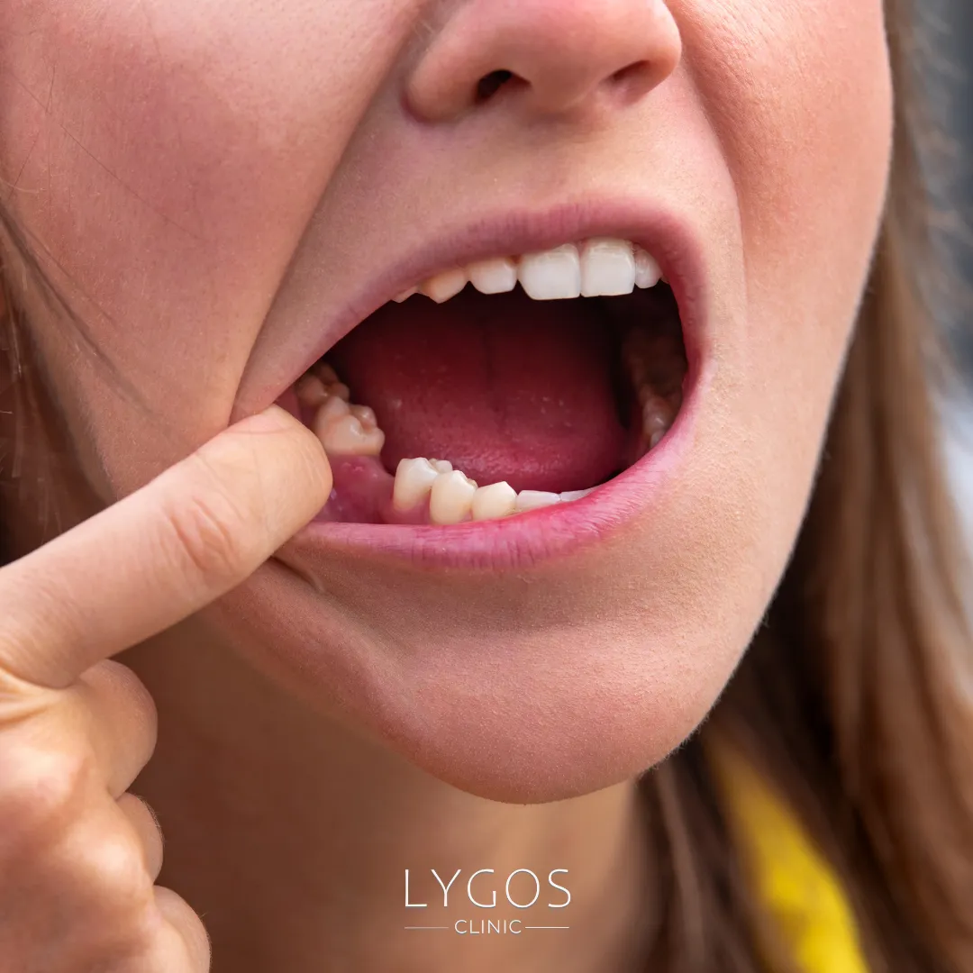 Teeth Shifting | Teeth Shifting After Braces | LYG 2025 1 Teeth Shifting