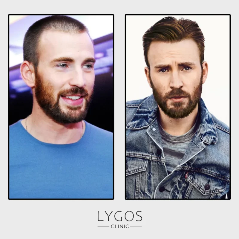 Chris Evans Hair Transplant