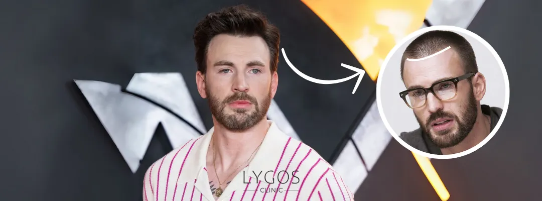 Chris Evans Saç Ekimi Yaptırdı mı?