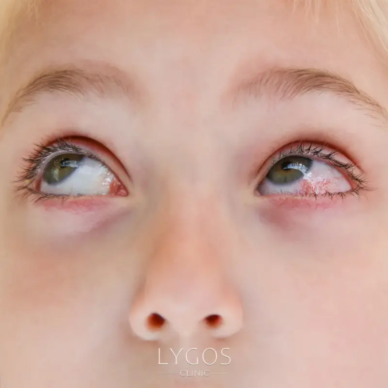 Conjunctivitis in Children