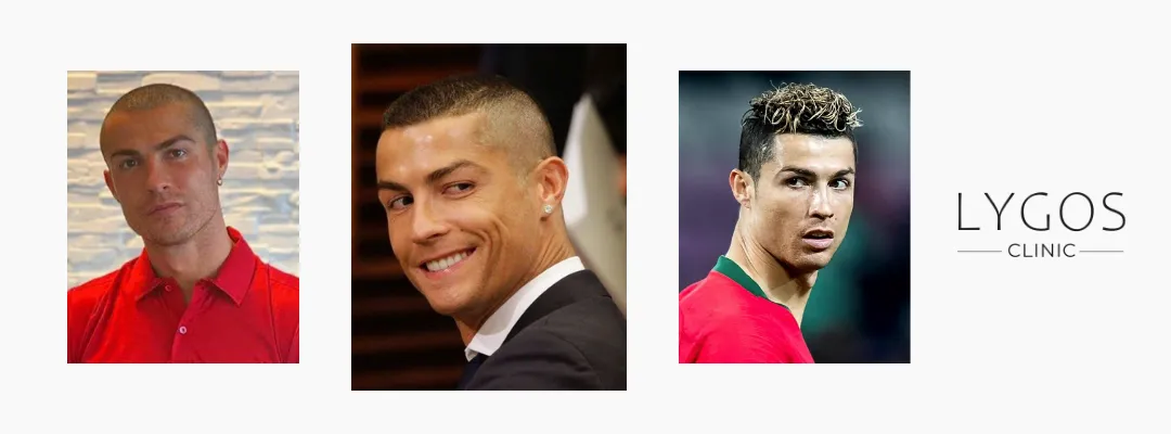 Cristiano Ronaldo Saç Ekimi İddiaları