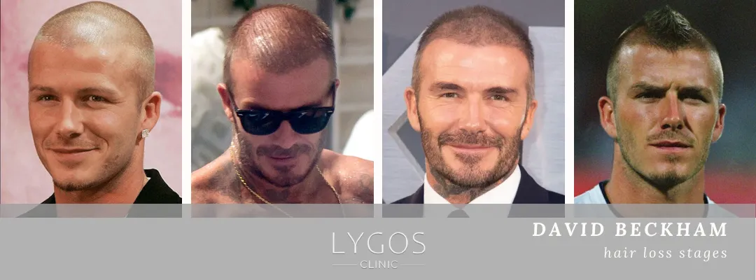 David Beckham Hair Loss