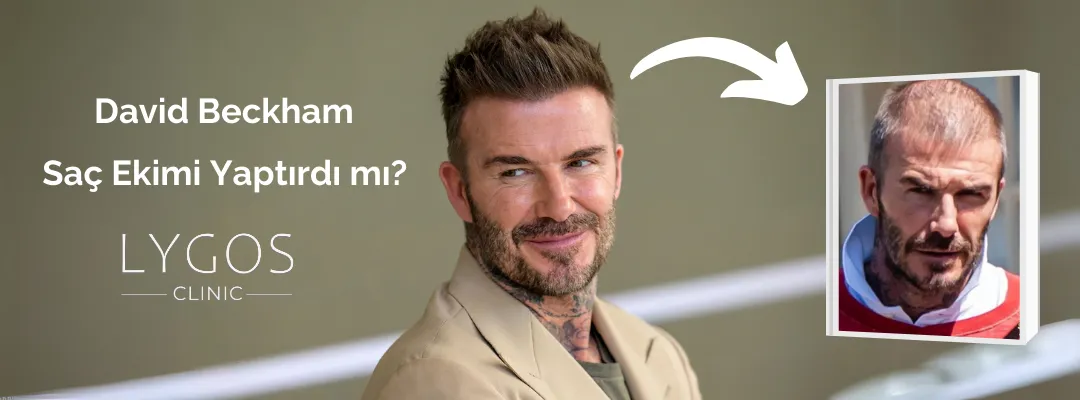 David Beckham Saç Ekimi Yaptırdı mı?