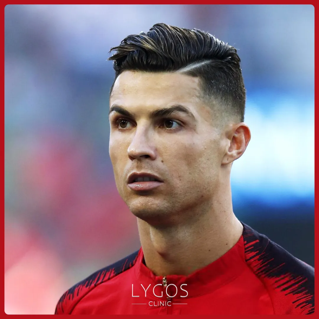 Did Cristiano Ronaldo Hair Transplant? | LYGOS 2025 1 Did Cristiano Ronaldo Hair Transplant