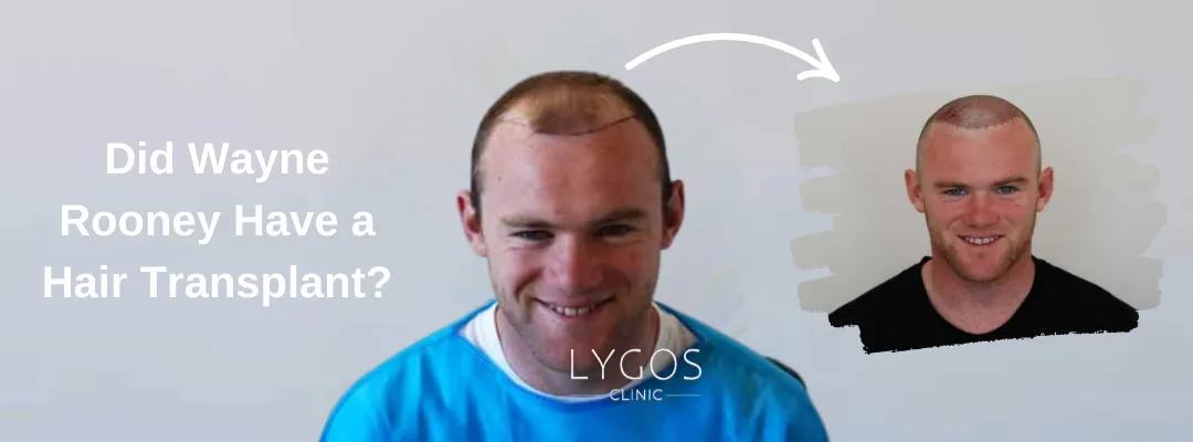 Did Wayne Rooney Have a Hair Transplant Surgery?