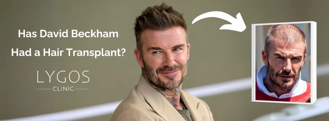 David Beckham’s Hair Transplant: The Impact