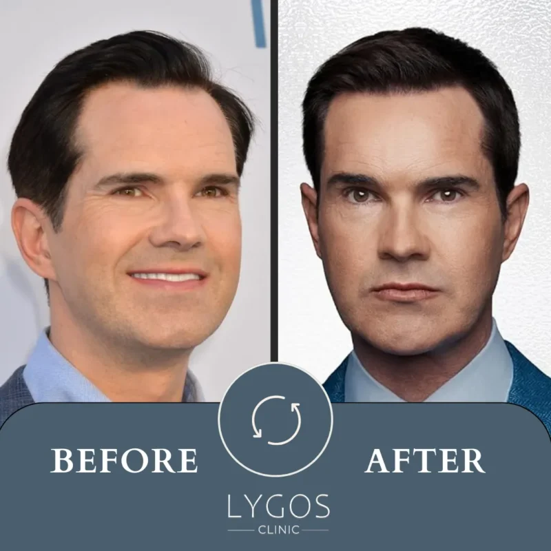Jimmy Carr Hair Transplant