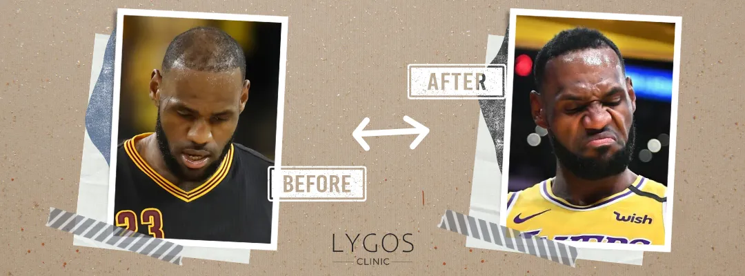 LeBron James Before and After Hair Transplant