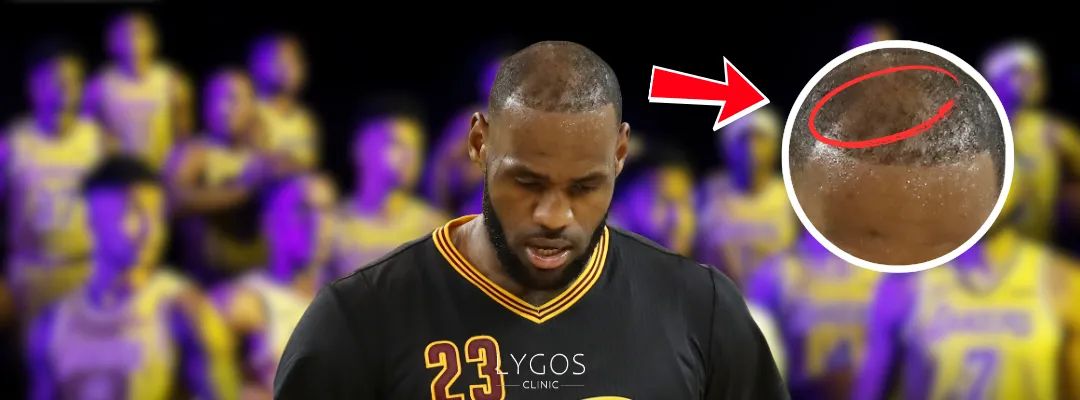 LeBron James Hair Loss