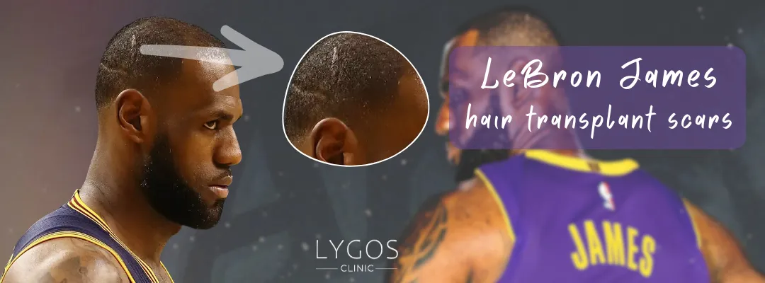 LeBron James Hair Transplant Scar