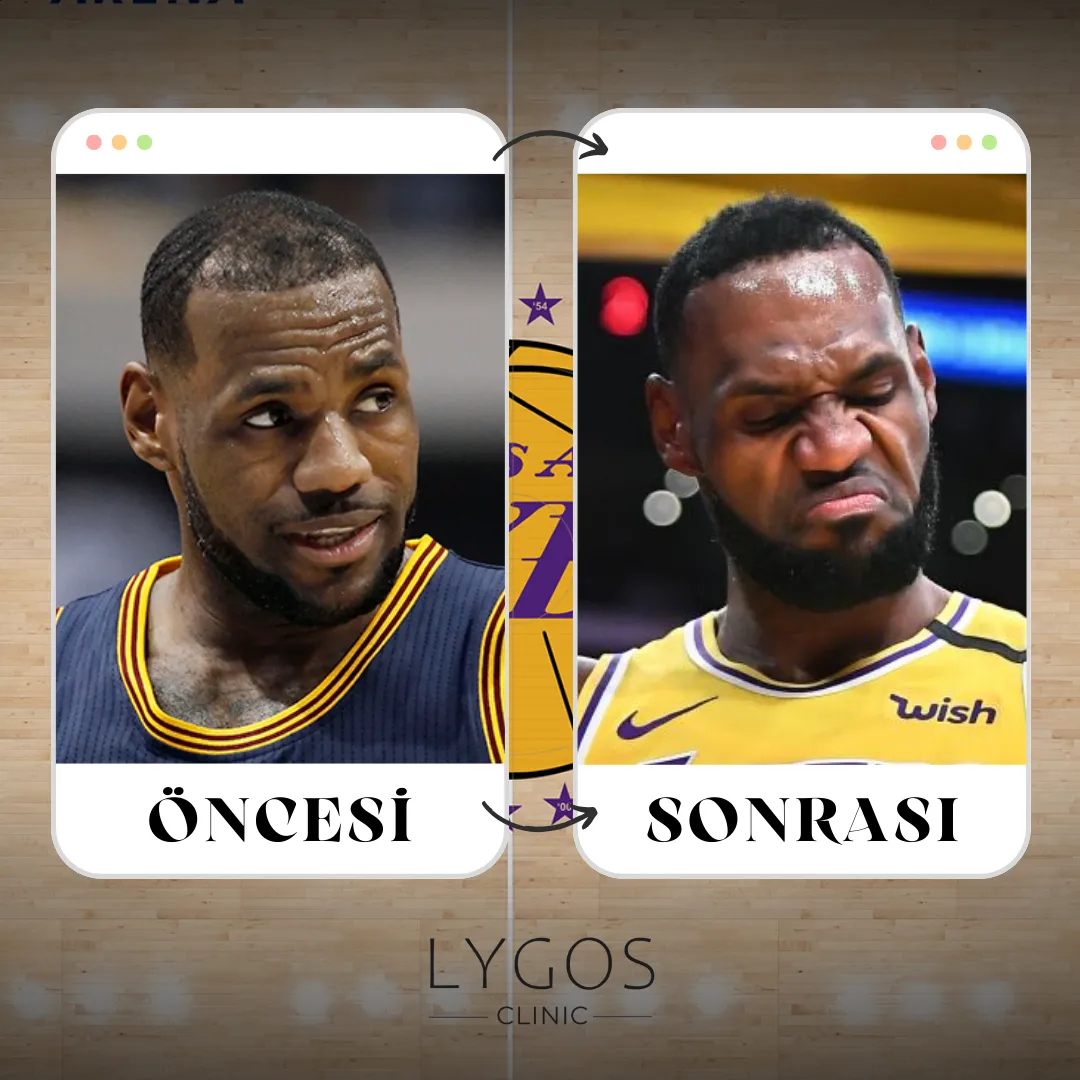 LeBron James Saç Ekimi | Öncesi ve Sonrası | LYG 2025 1 LeBron James Saç Ekimi