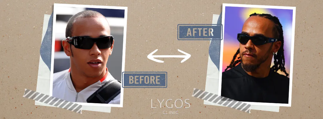 Lewis Hamilton Before and After Hair Transplant