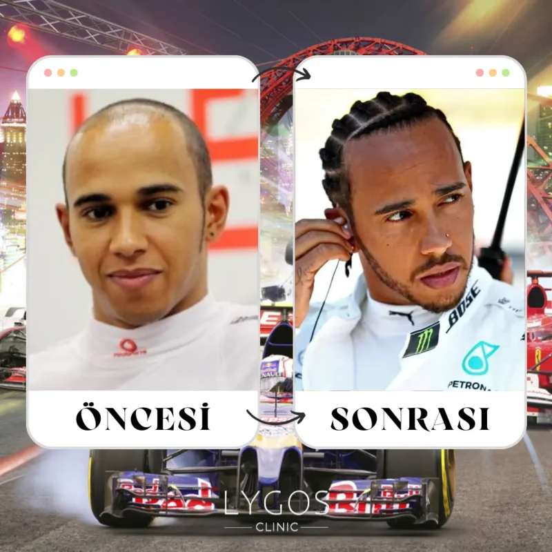 Lewis Hamilton Saç Ekimi