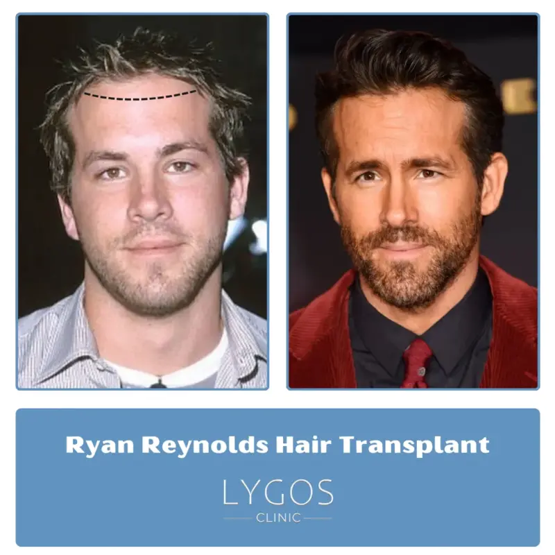 Ryan Reynolds Hair Transplant