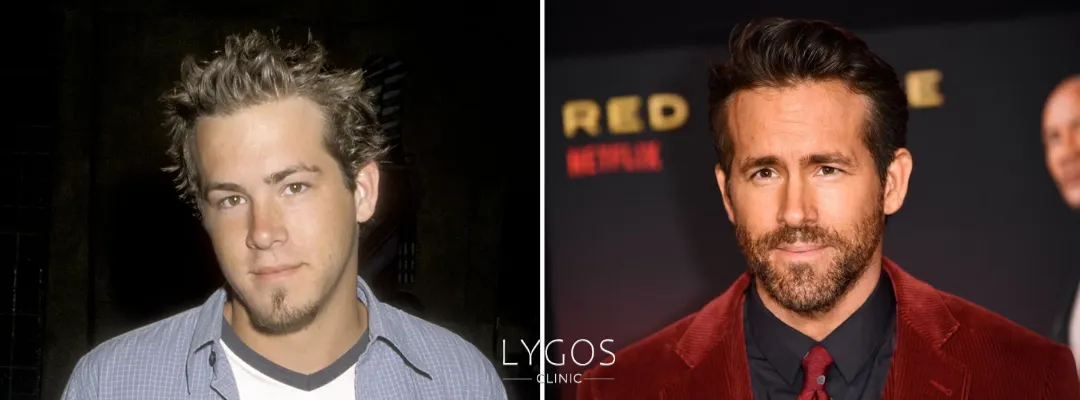 Ryan Reynolds Hair Transplant Before and After