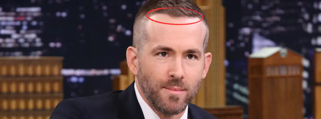 Ryan Reynolds Saç Dökülmesi