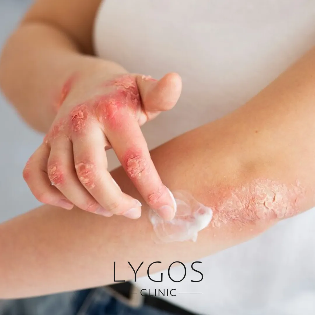 Seborrheic Dermatitis | Symptoms and Causes | LYGOS 2025 1 Seborrheic Dermatitis