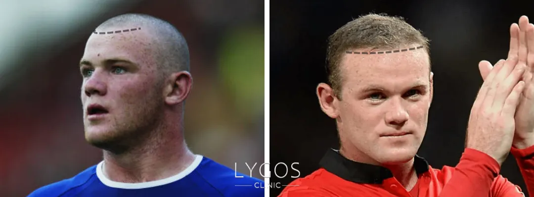 Wayne Rooney Before And After Hair Transplant