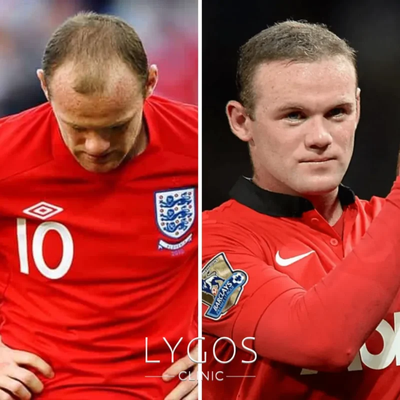 Wayne Rooney Hair Transplant