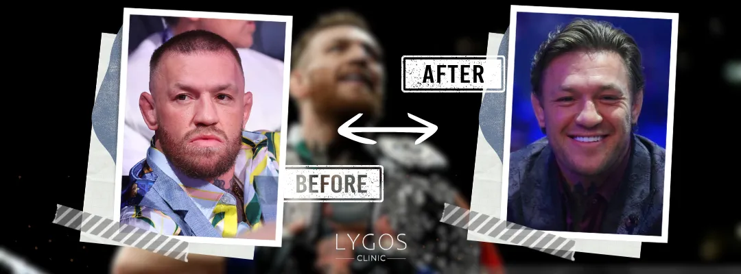 Conor McGregor Before and After Hair Transplant